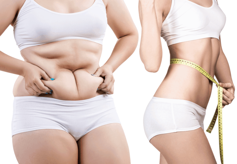 What Are the Recovery and Aftercare Guidelines for Liposuction?