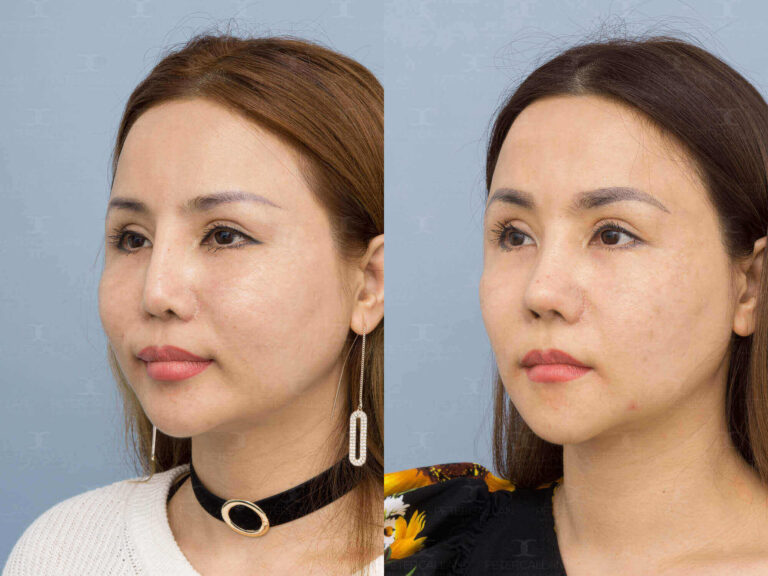 Who Would Benefit from a Non-Surgical Nose Job?