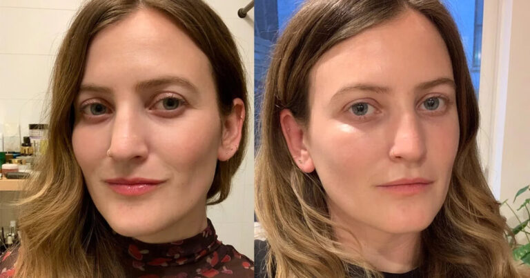 How to use “eye-filler” to enhance your appearance